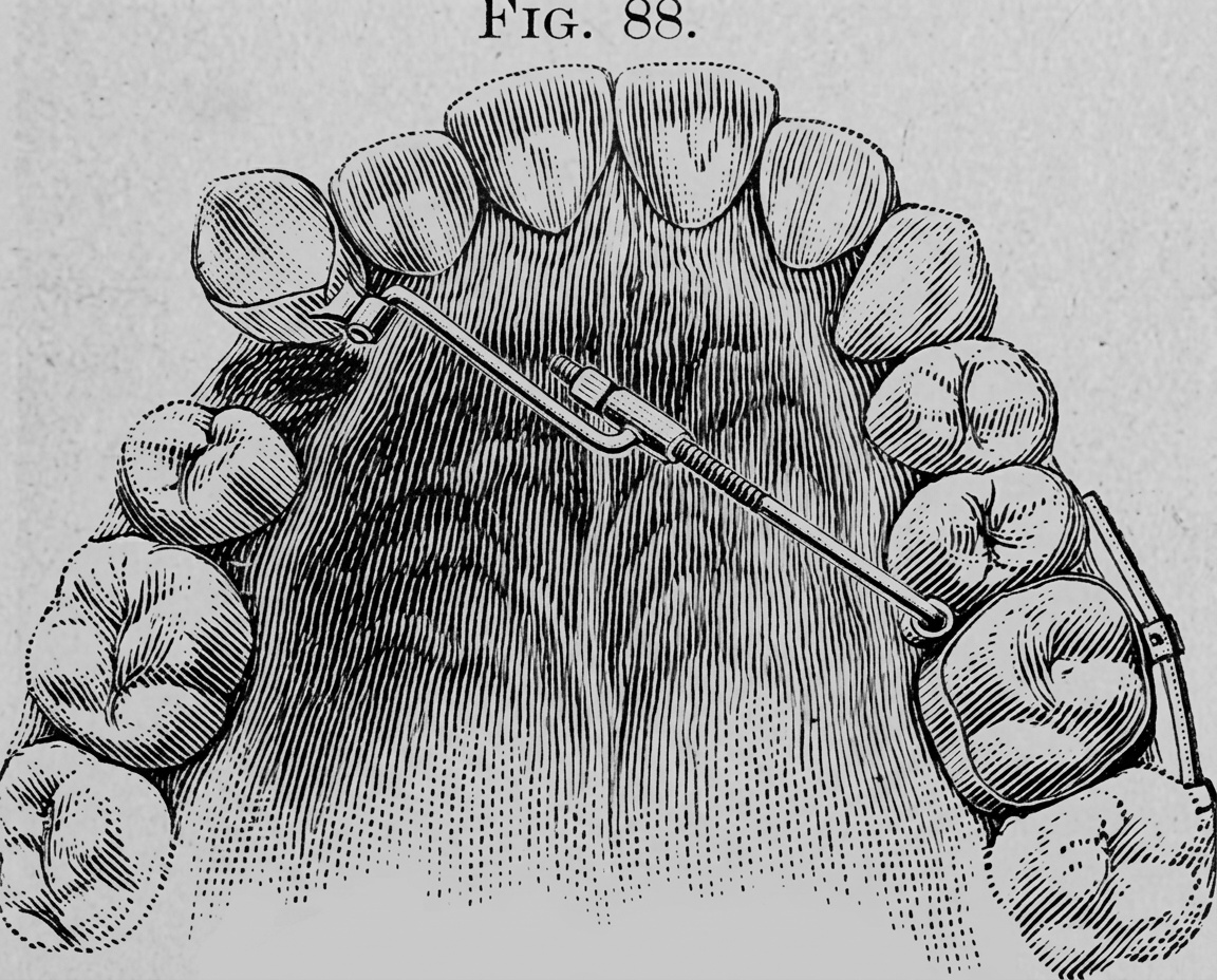 Black-and-white vintage illustration of the upper palate and a dental instrument